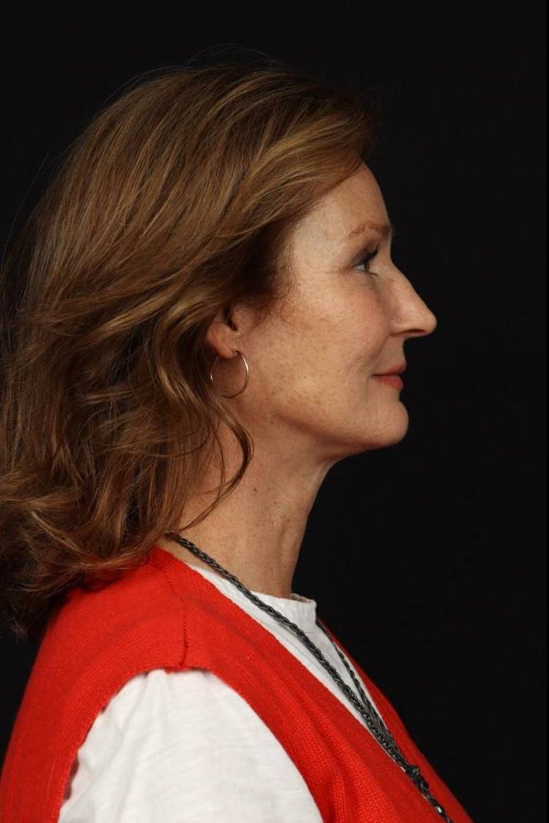 Facelift Before & After Gallery - Patient 308205 - Image 10