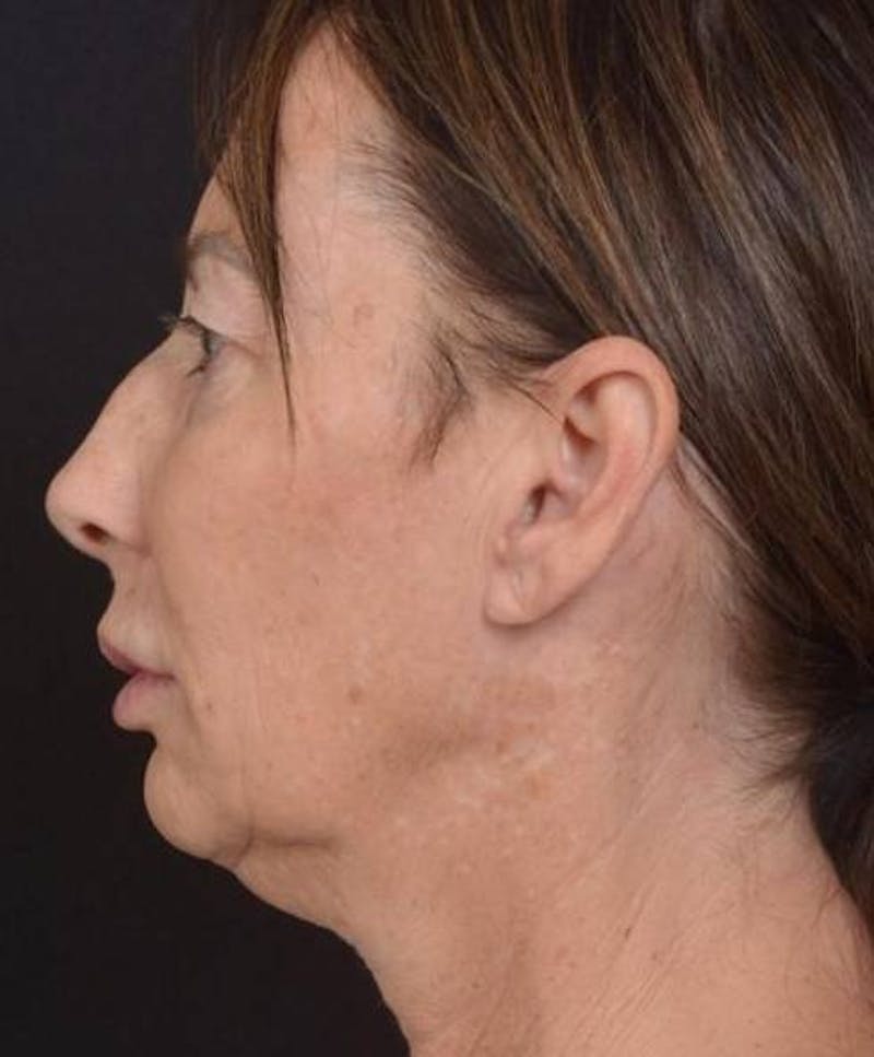 Facelift Before & After Gallery - Patient 346802 - Image 3