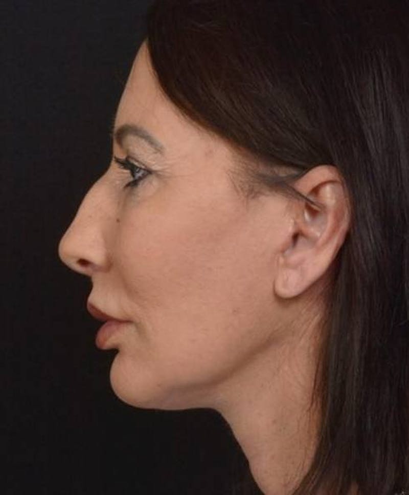 Facelift Before & After Gallery - Patient 346802 - Image 4