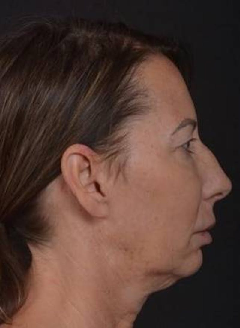 Facelift Before & After Gallery - Patient 346802 - Image 5