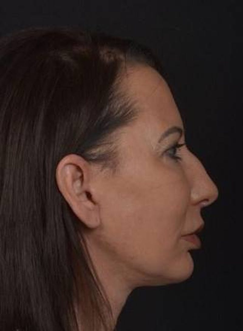 Facelift Before & After Gallery - Patient 346802 - Image 6