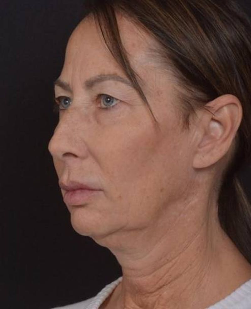 Facelift Before & After Gallery - Patient 346802 - Image 7