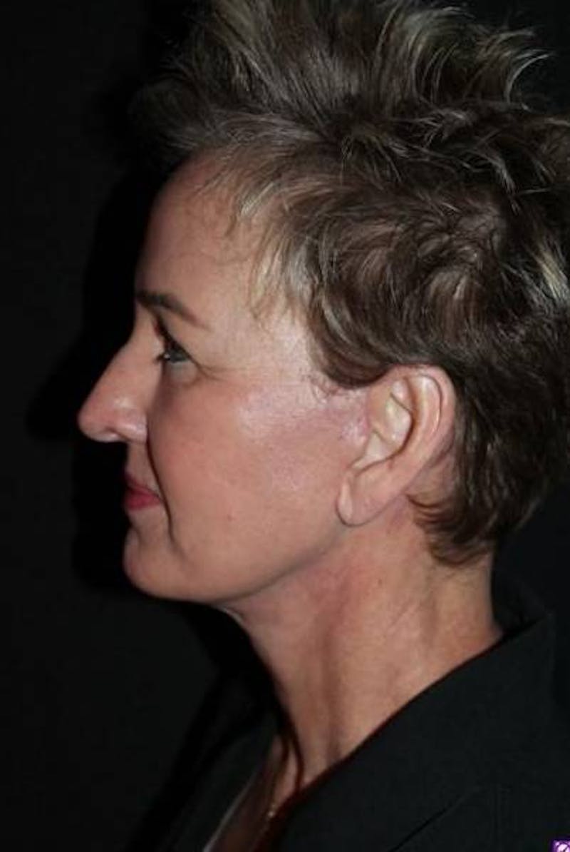 Facelift Before & After Gallery - Patient 865014 - Image 6