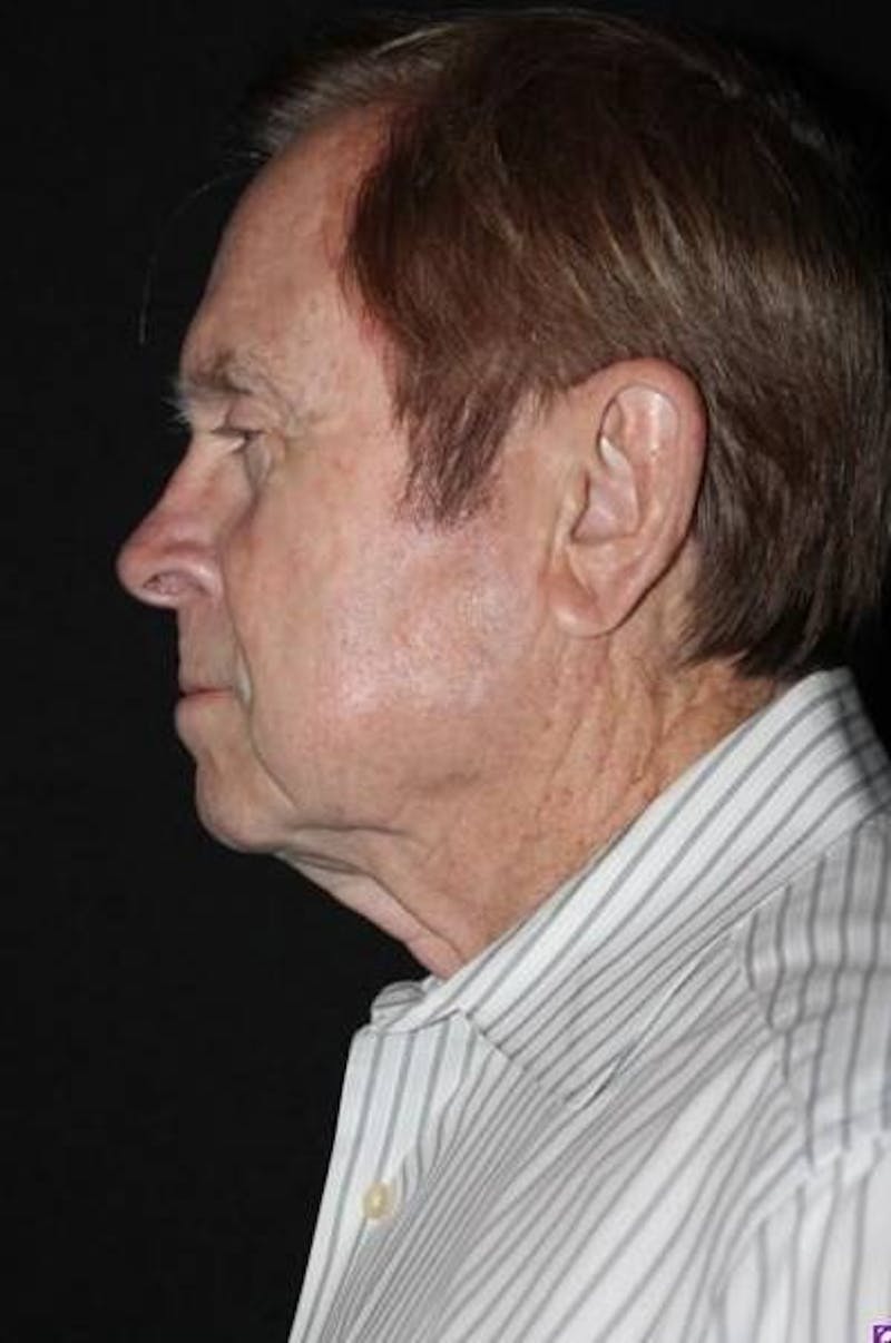 Facelift Before & After Gallery - Patient 295117 - Image 5
