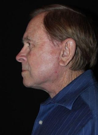 Facelift Before & After Gallery - Patient 295117 - Image 6