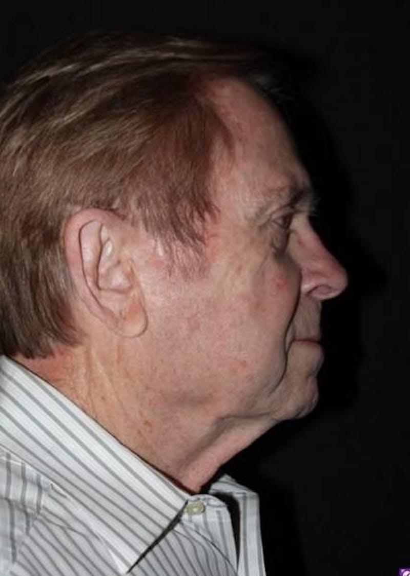 Facelift Before & After Gallery - Patient 295117 - Image 9
