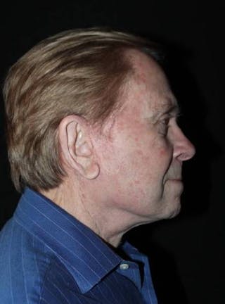 Facelift Before & After Gallery - Patient 295117 - Image 10