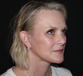 Facelift Before & After Gallery - Patient 189855 - Image 8