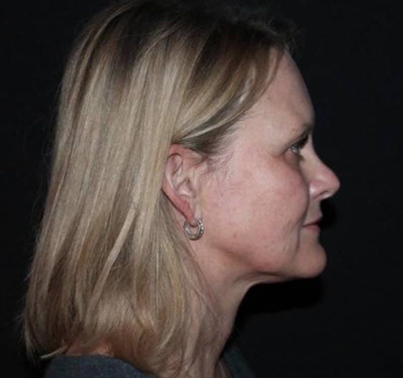 Facelift Before & After Gallery - Patient 189855 - Image 9