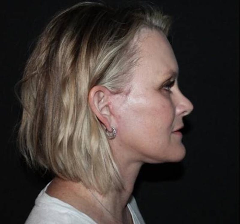 Facelift Before & After Gallery - Patient 189855 - Image 10