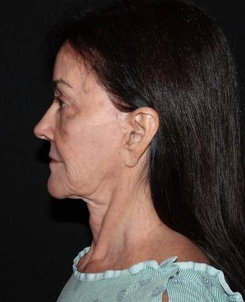 Facelift Before & After Gallery - Patient 343672 - Image 5