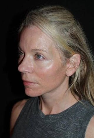 Facelift Before & After Gallery - Patient 374683 - Image 4