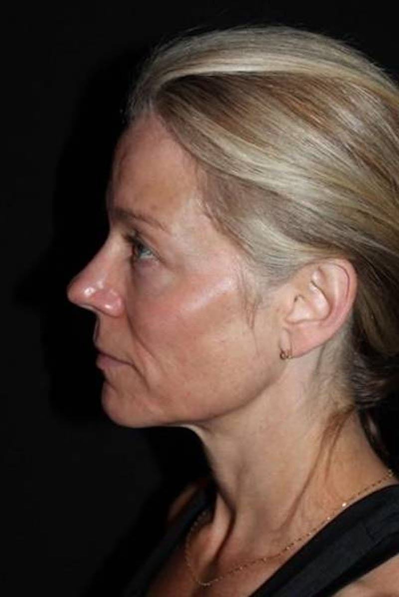Facelift Before & After Gallery - Patient 374683 - Image 5