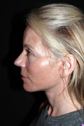 Facelift Before & After Gallery - Patient 374683 - Image 6