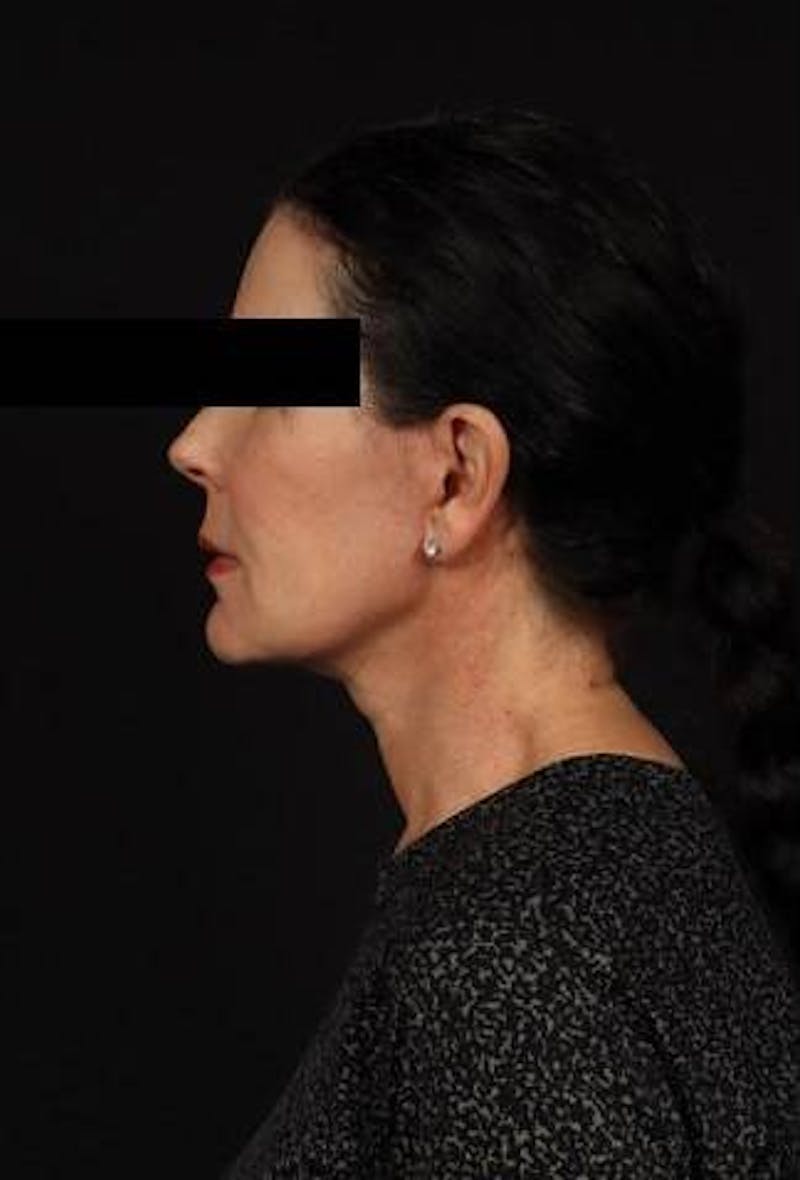Facelift Before & After Gallery - Patient 373299 - Image 6