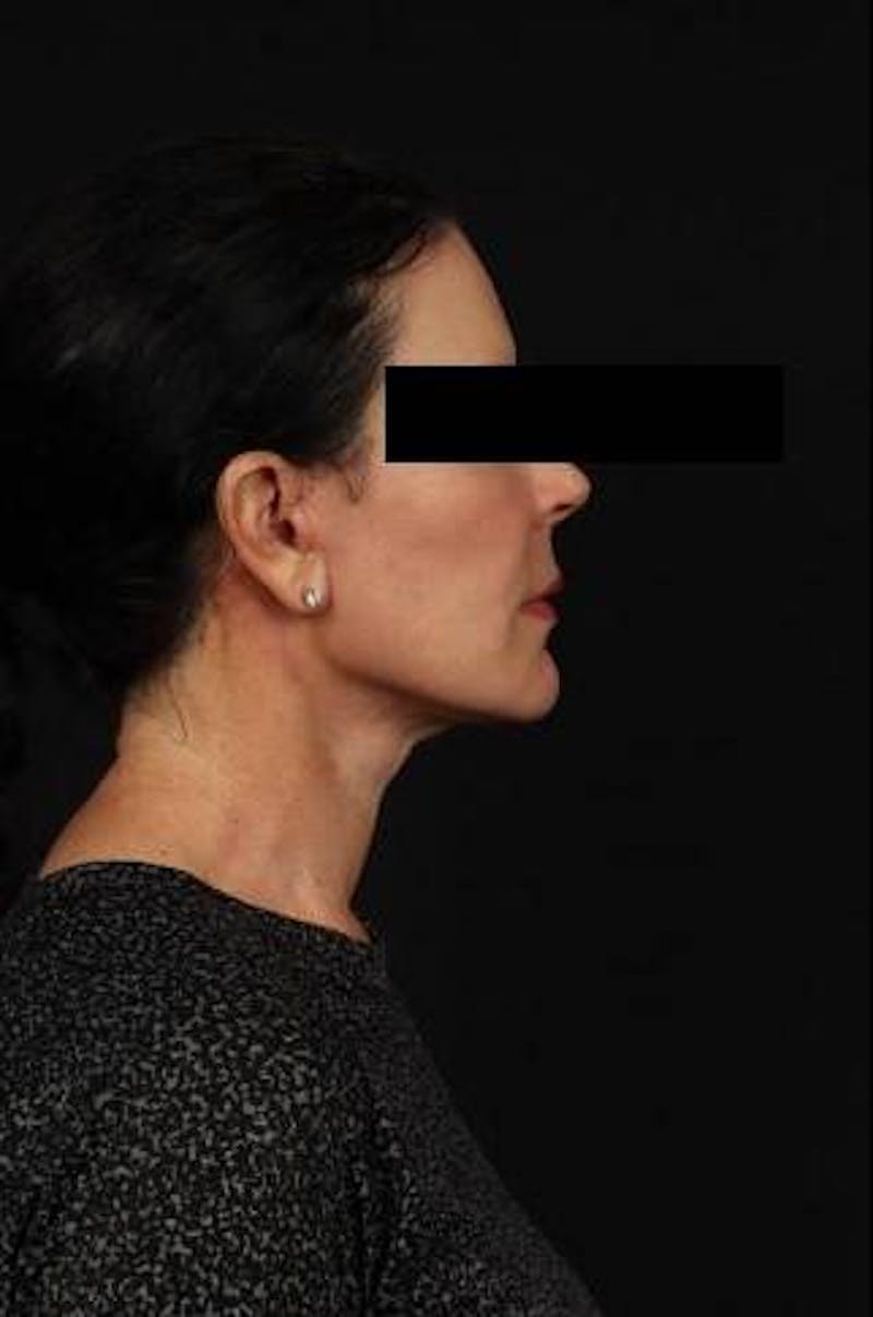 Facelift Before & After Gallery - Patient 373299 - Image 10