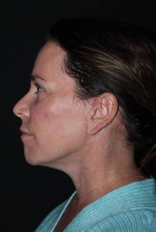 Facelift Before & After Gallery - Patient 391777 - Image 6