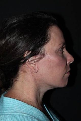 Facelift Before & After Gallery - Patient 391777 - Image 10