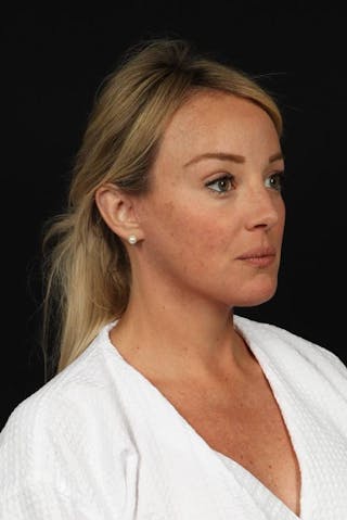 Facelift Before & After Gallery - Patient 184049 - Image 8