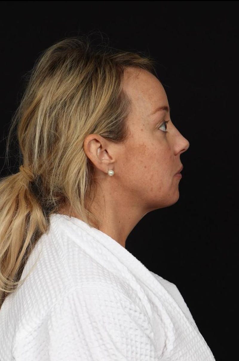 Facelift Before & After Gallery - Patient 184049 - Image 9