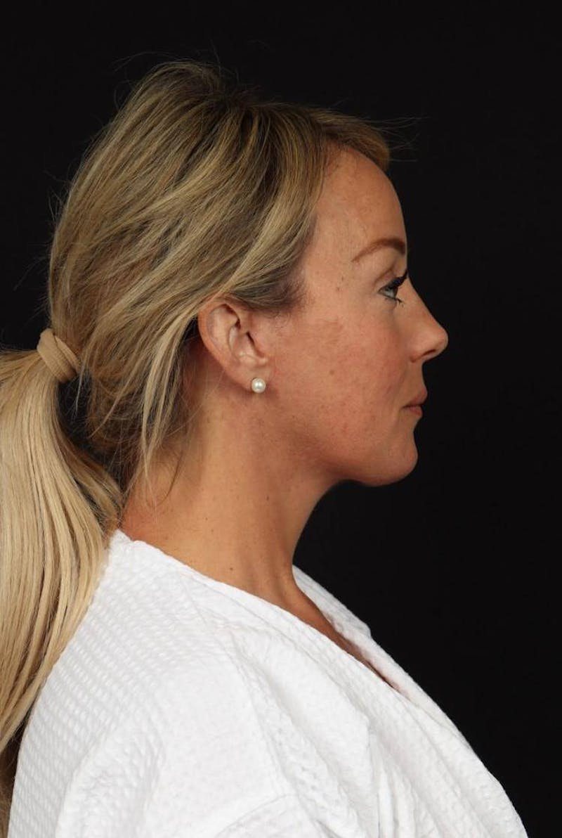 Facelift Before & After Gallery - Patient 184049 - Image 10