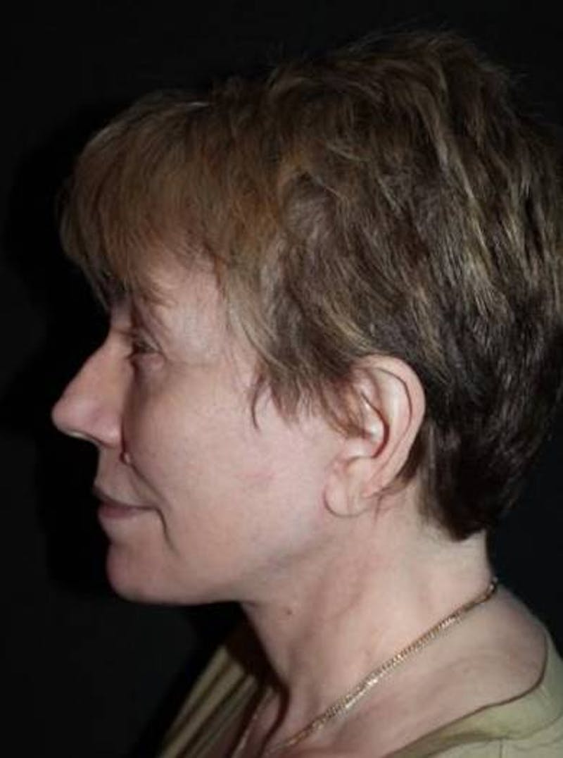 Facelift Before & After Gallery - Patient 384909 - Image 6