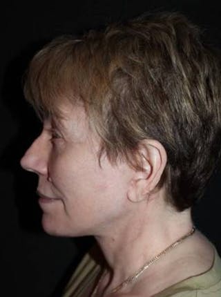 Facelift Before & After Gallery - Patient 384909 - Image 6