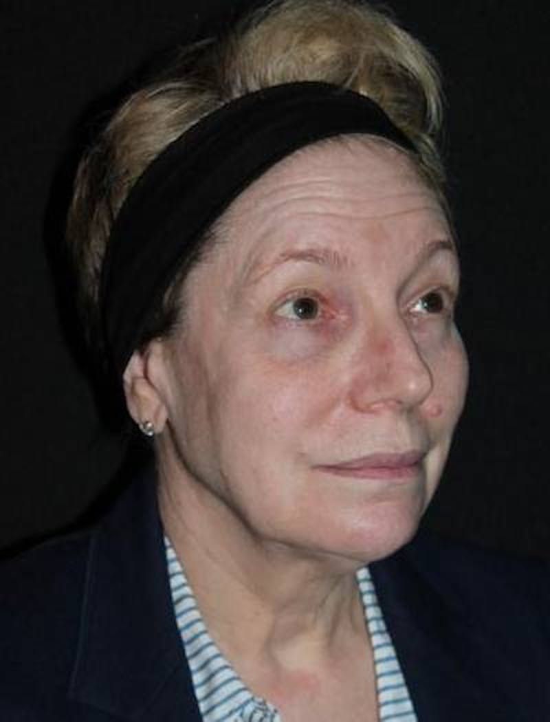 Facelift Before & After Gallery - Patient 384909 - Image 7