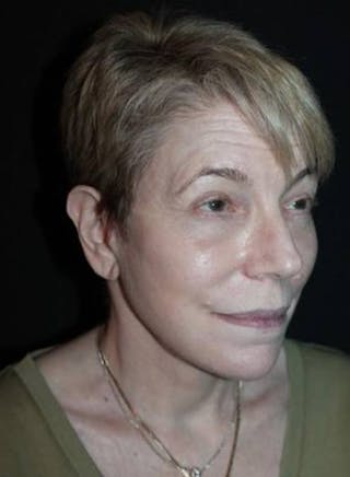 Facelift Before & After Gallery - Patient 384909 - Image 8