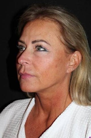 Facelift Before & After Gallery - Patient 104007 - Image 4