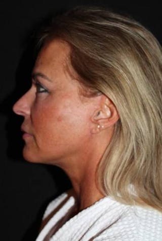 Facelift Before & After Gallery - Patient 104007 - Image 6