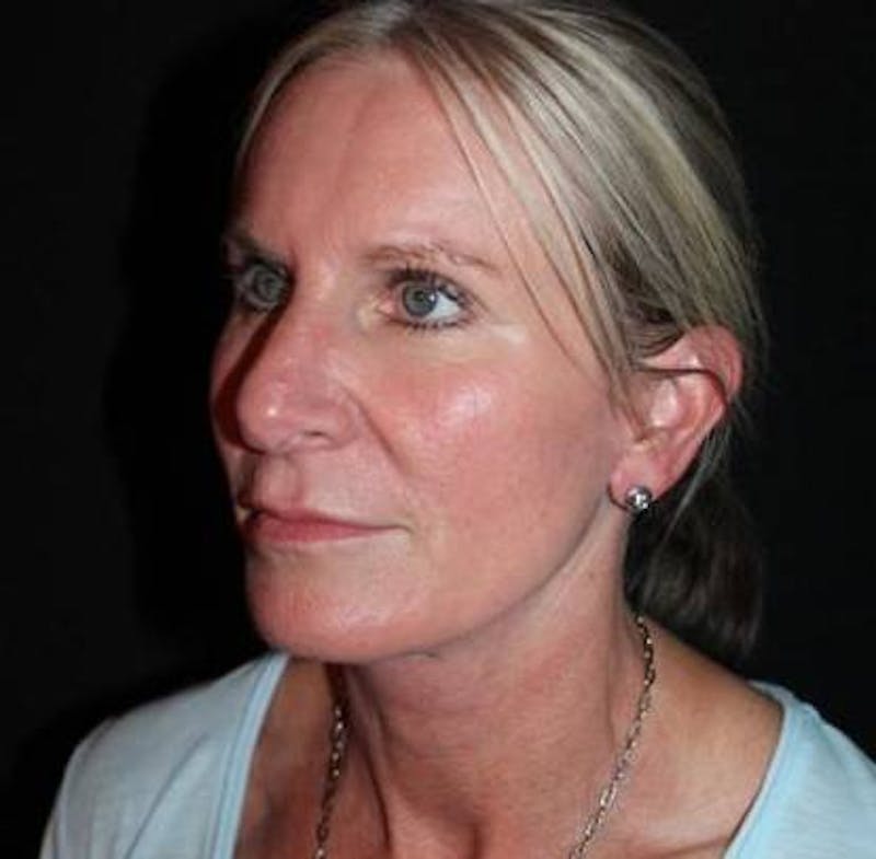 Facelift Before & After Gallery - Patient 508185 - Image 4
