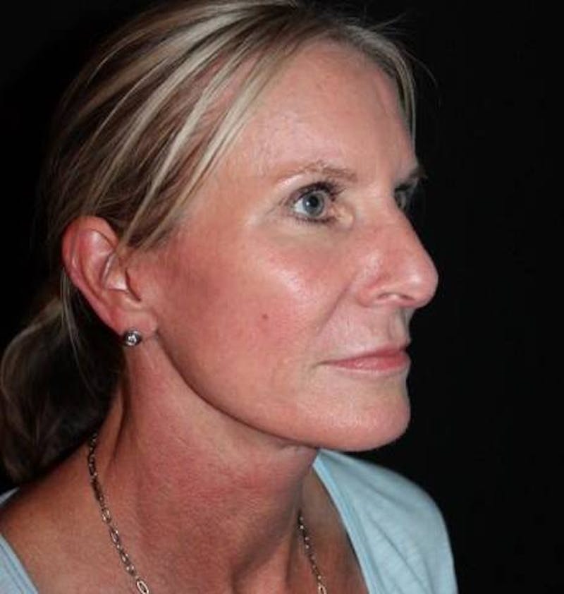 Facelift Before & After Gallery - Patient 508185 - Image 8