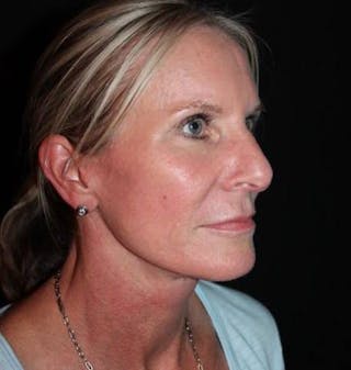 Facelift Before & After Gallery - Patient 508185 - Image 8
