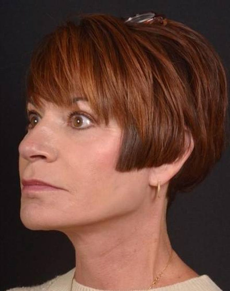 Facelift Before & After Gallery - Patient 466246 - Image 4