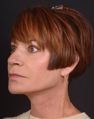 Facelift Before & After Gallery - Patient 466246 - Image 4