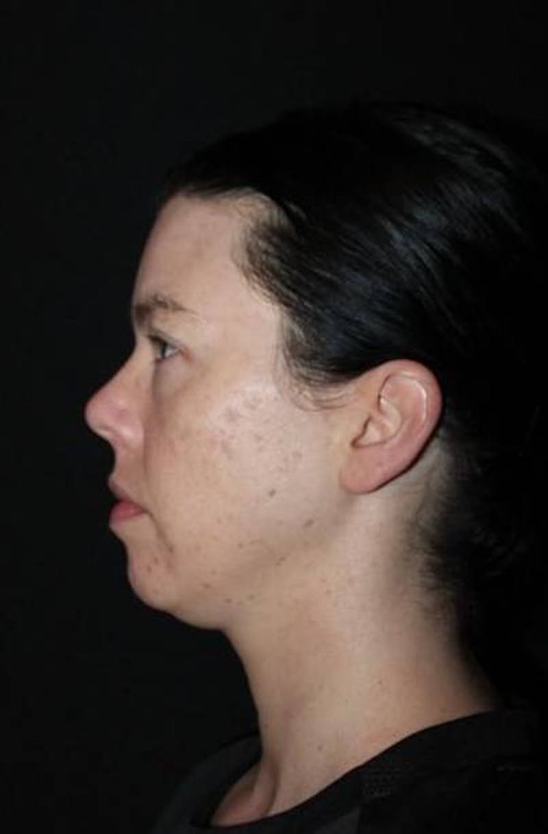 Neck Liposuction Before & After Gallery - Patient 163859 - Image 5