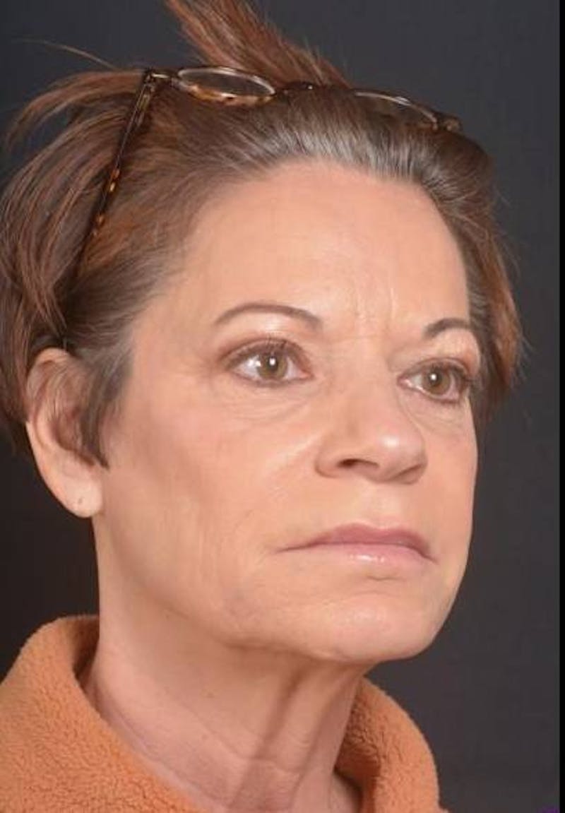 Facelift Before & After Gallery - Patient 466246 - Image 5