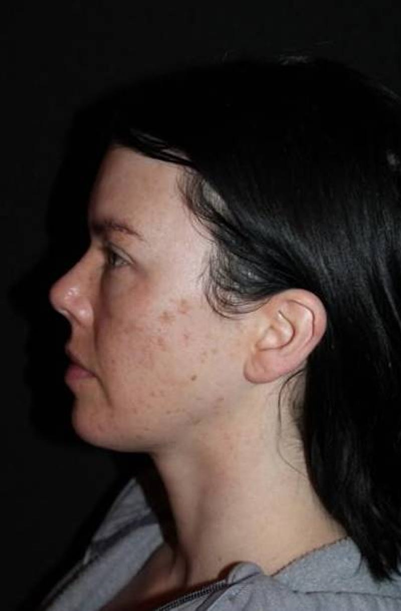 Neck Liposuction Before & After Gallery - Patient 163859 - Image 6