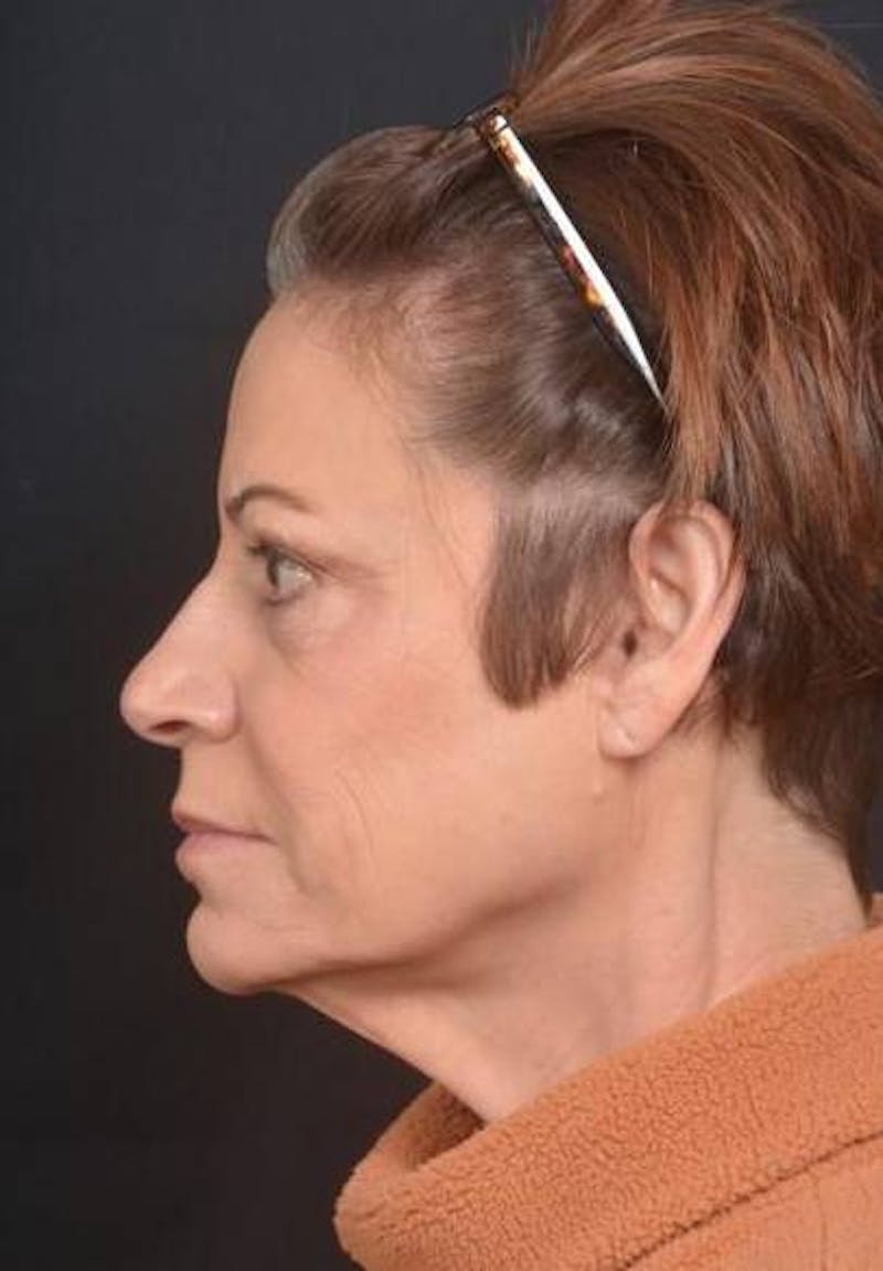 Facelift Before & After Gallery - Patient 466246 - Image 7