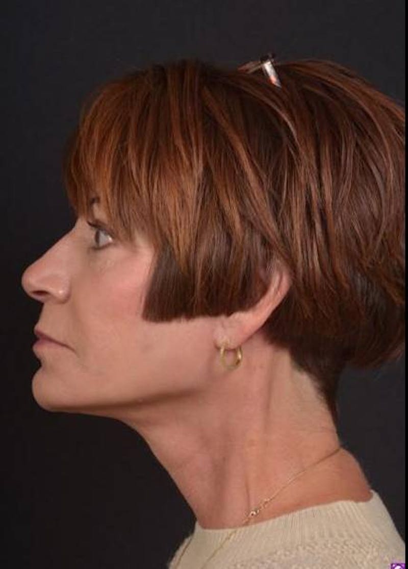 Facelift Before & After Gallery - Patient 466246 - Image 8