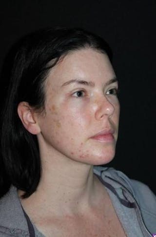 Neck Liposuction Before & After Gallery - Patient 163859 - Image 8