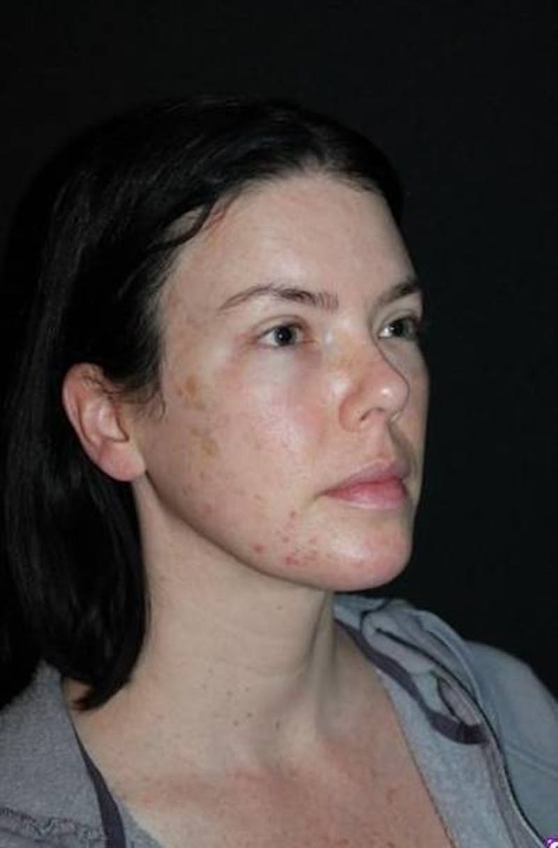 Neck Liposuction Before & After Gallery - Patient 163859 - Image 8