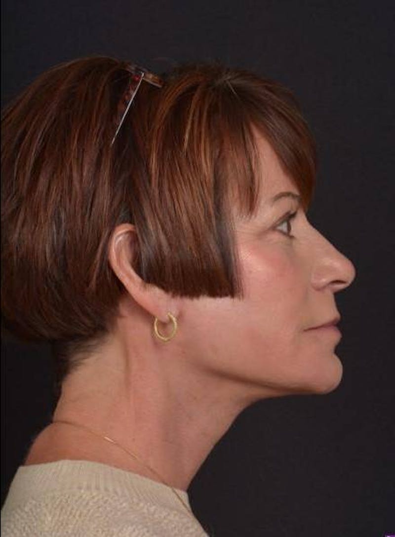 Facelift Before & After Gallery - Patient 466246 - Image 10