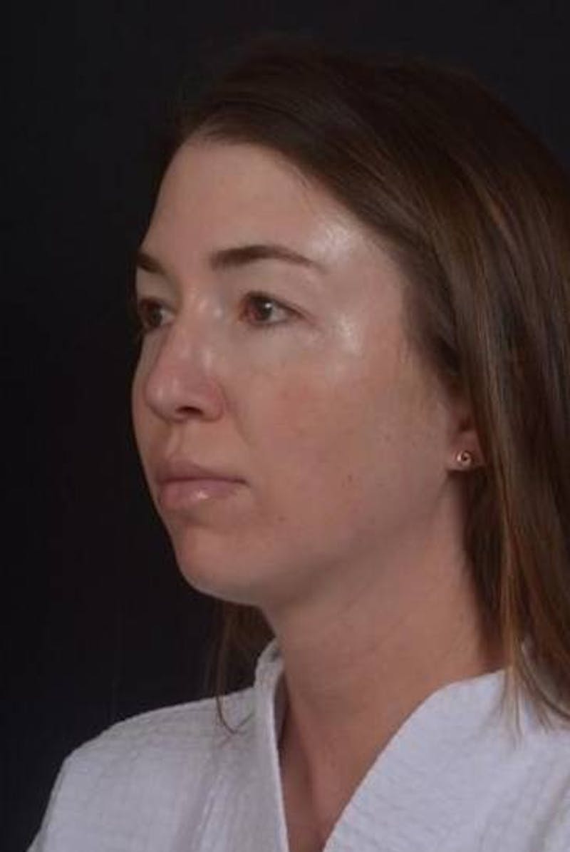 Neck Liposuction Before & After Gallery - Patient 269153 - Image 3