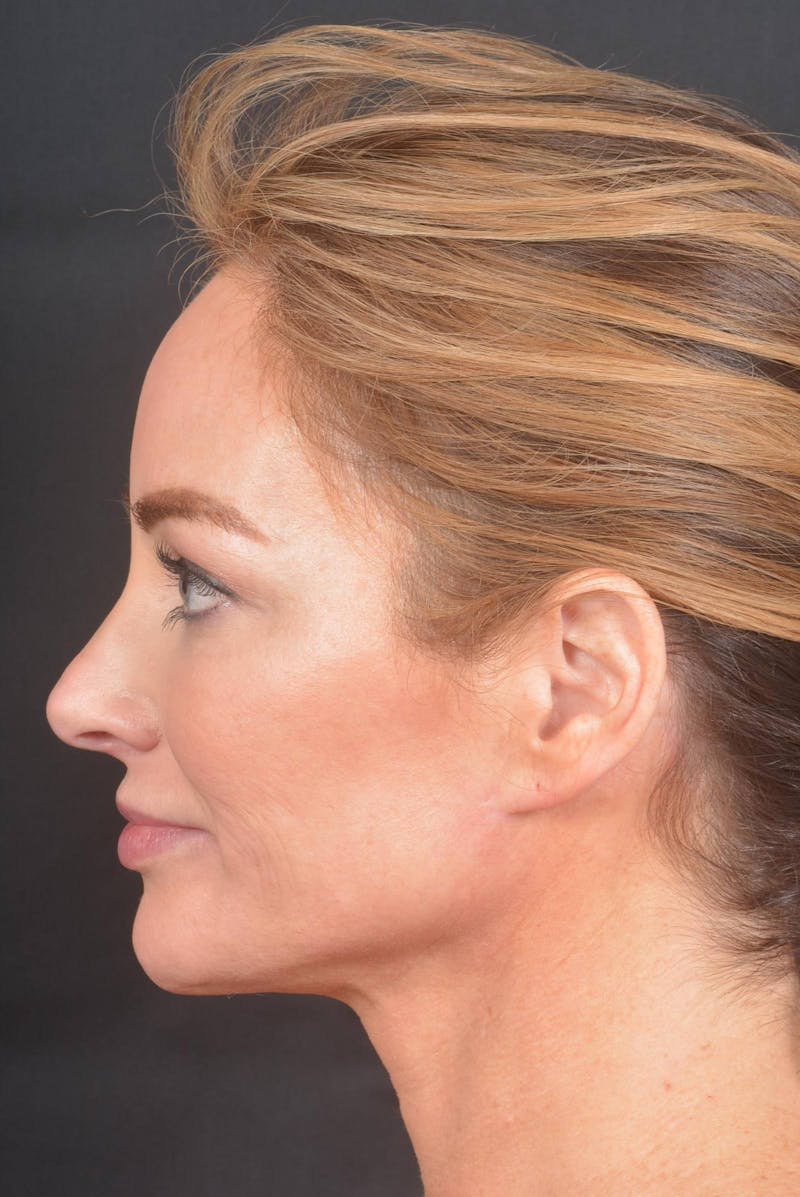 Facelift Before & After Gallery - Patient 418461 - Image 4