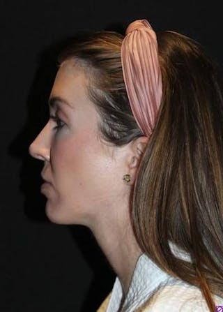 Neck Liposuction Before & After Gallery - Patient 269153 - Image 6