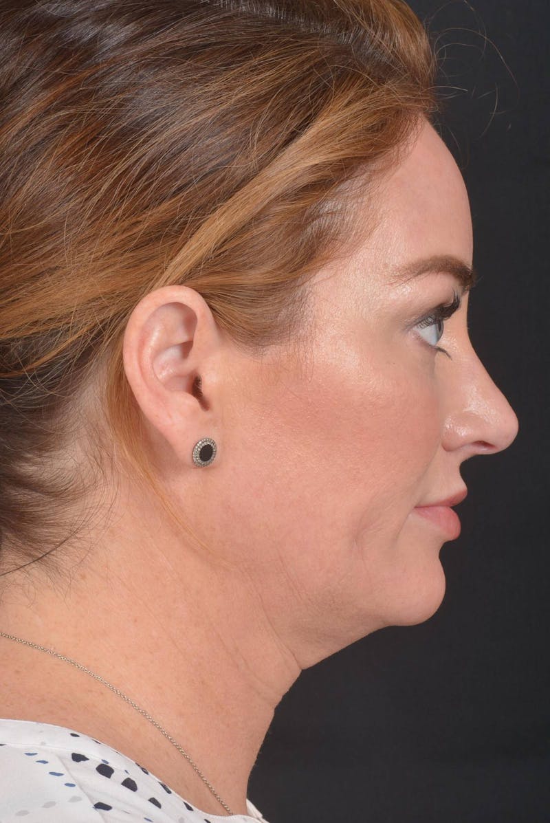 Facelift Before & After Gallery - Patient 418461 - Image 5