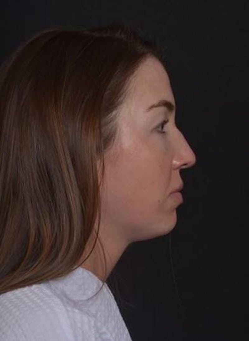 Neck Liposuction Before & After Gallery - Patient 269153 - Image 9