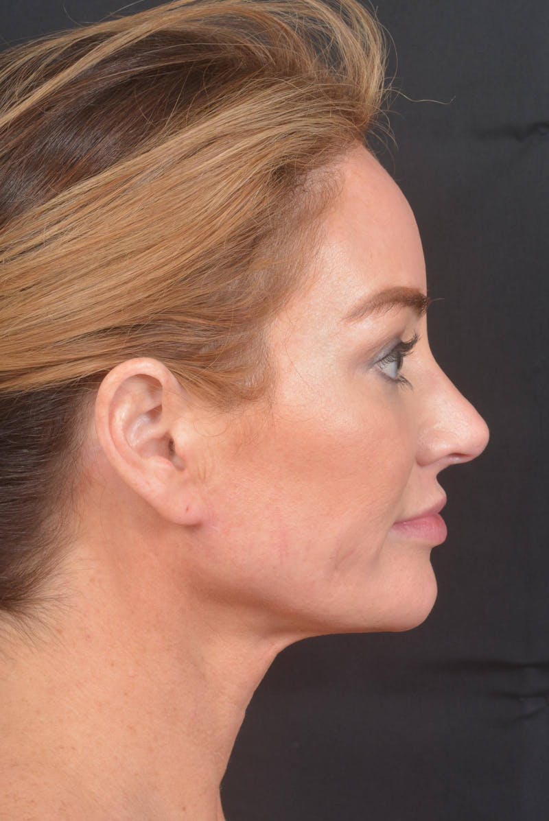 Facelift Before & After Gallery - Patient 418461 - Image 6